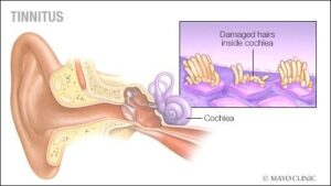 Tinnitus Treatment in Lahore & Pure Tone Audiometry Test